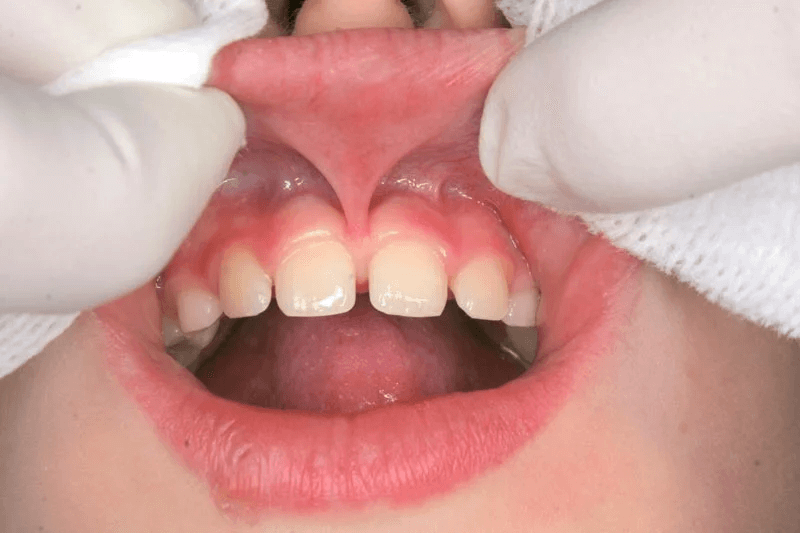 frenulum