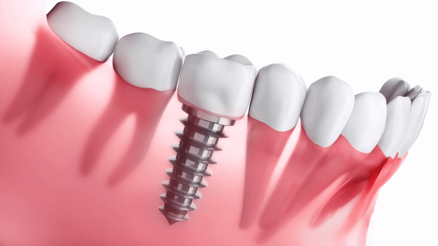 Zapleti Zobnega Implantata